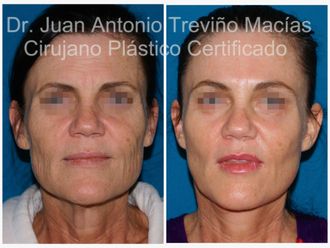 Lipólisis antes y después - 874786