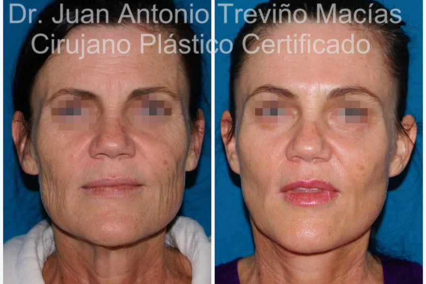 Lipólisis antes y después - 874786