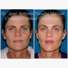 Lifting Facial -Centro de Cirugía Plástica. Dr. Juan Antonio Treviño Macías