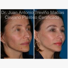 Lifting Facial - Centro de Cirugía Plástica. Dr. Juan Antonio Treviño Macías