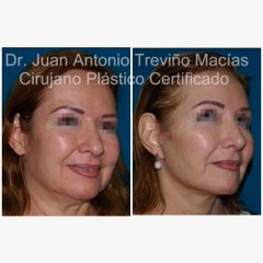 Lifting Facial - Centro de Cirugía Plástica. Dr. Juan Antonio Treviño Macías