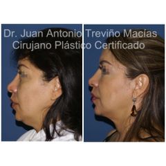 Lifting Facial -Centro de Cirugía Plástica. Dr. Juan Antonio Treviño Macías