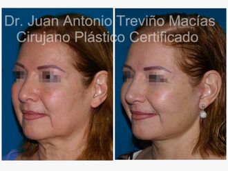 Lifting antes y después - 874790