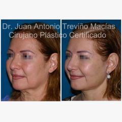 Lifting Facial -Centro de Cirugía Plástica. Dr. Juan Antonio Treviño Macías
