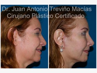 Lifting antes y después - 874791
