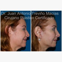 Lifting Facial -Centro de Cirugía Plástica. Dr. Juan Antonio Treviño Macías