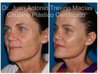 Lifting antes y después - 874792