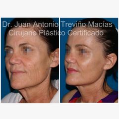 Lifting Facial -Centro de Cirugía Plástica. Dr. Juan Antonio Treviño Macías