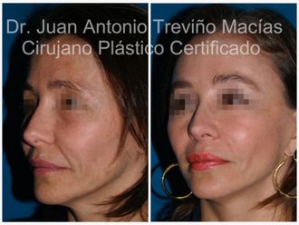 Lifting antes y después - 874793
