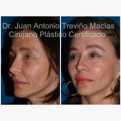 Lifting Facial - Centro de Cirugía Plástica. Dr. Juan Antonio Treviño Macías