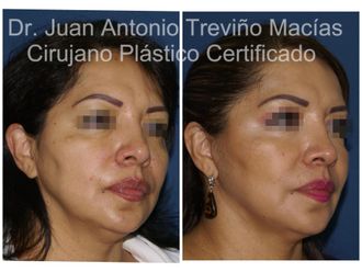 Lifting antes y después - 874794