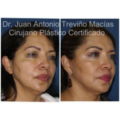 Lifting Facial -Centro de Cirugía Plástica. Dr. Juan Antonio Treviño Macías