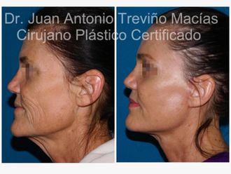 Lifting antes y después - 874795