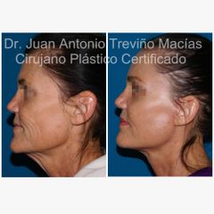 Lifting Facial - Centro de Cirugía Plástica. Dr. Juan Antonio Treviño Macías