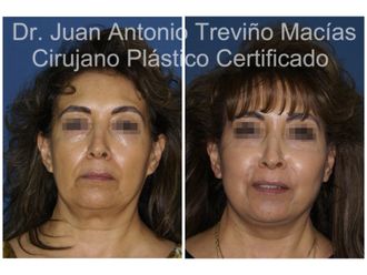 Lifting antes y después - 874796
