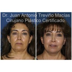 Lifting Facial -Centro de Cirugía Plástica. Dr. Juan Antonio Treviño Macías