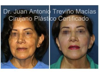 Lifting antes y después - 874797