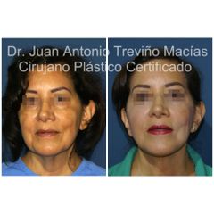 Lifting Facial -Centro de Cirugía Plástica. Dr. Juan Antonio Treviño Macías