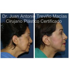 Lifting Facial - Centro de Cirugía Plástica. Dr. Juan Antonio Treviño Macías