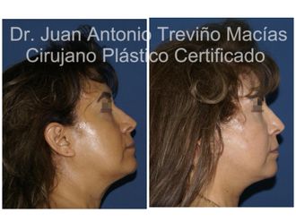 Lifting antes y después - 874800