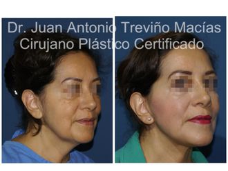 Lifting antes y después - 874801