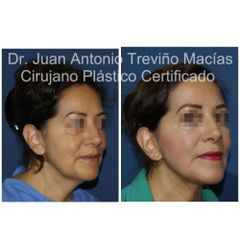 Lifting Facial - Centro de Cirugía Plástica. Dr. Juan Antonio Treviño Macías