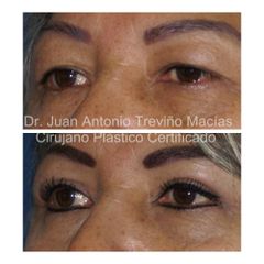 Blefaroplastia - Centro de Cirugía Plástica. Dr. Juan Antonio Treviño Macías