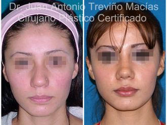 Rinoplastia antes y después - 874976