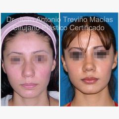 Rinoplastia - Centro de Cirugía Plástica. Dr. Juan Antonio Treviño Macías