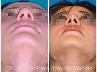 Rinoplastia antes y después - 874977