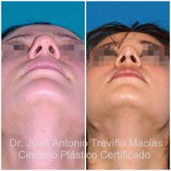 Rinoplastia - Centro de Cirugía Plástica. Dr. Juan Antonio Treviño Macías