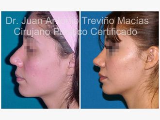 Rinoplastia antes y después - 874978
