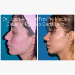 Rinoplastia - Centro de Cirugía Plástica. Dr. Juan Antonio Treviño Macías