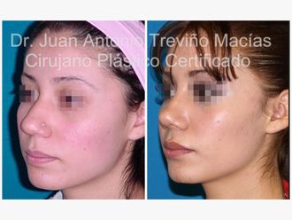 Rinoplastia antes y después - 874979