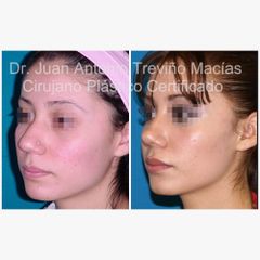 Rinoplastia - Centro de Cirugía Plástica. Dr. Juan Antonio Treviño Macías