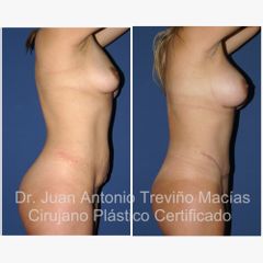 Mommy Makeover - Centro de Cirugía Plástica. Dr. Juan Antonio Treviño Macías