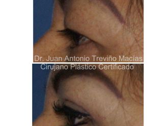 Blefaroplastia antes y después - 874983