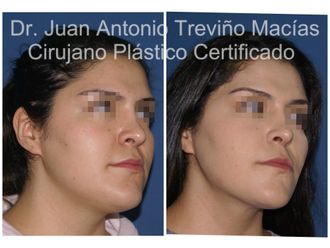 Cirugía facial antes y después - 874984