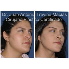 Cirugia Facial - Centro de Cirugía Plástica. Dr. Juan Antonio Treviño Macías