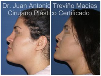 Cirugía facial antes y después - 874985