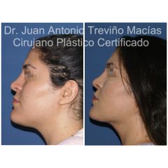 Cirugia Facial - Centro de Cirugía Plástica. Dr. Juan Antonio Treviño Macías