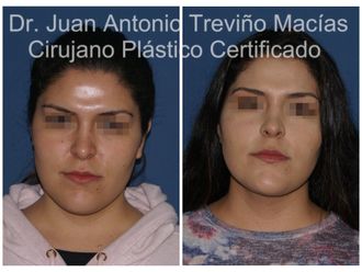 Cirugía facial antes y después - 874986