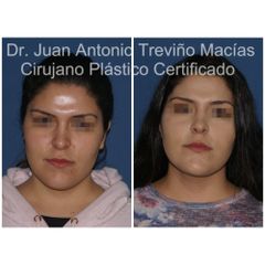 Cirugia Facial - Centro de Cirugía Plástica. Dr. Juan Antonio Treviño Macías