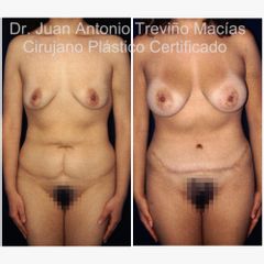 Mommy Makeover - Centro de Cirugía Plástica. Dr. Juan Antonio Treviño Macías