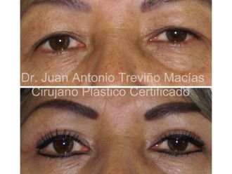 Blefaroplastia antes y después - 874988