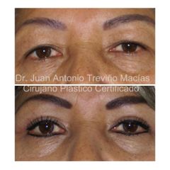 Blefaroplastia - Centro de Cirugía Plástica. Dr. Juan Antonio Treviño Macías