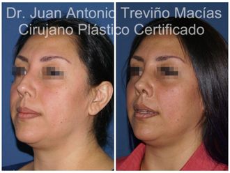 Rinoplastia antes y después - 874989