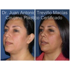 Rinoplastia - Centro de Cirugía Plástica. Dr. Juan Antonio Treviño Macías