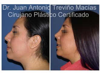 Rinoplastia antes y después - 874990