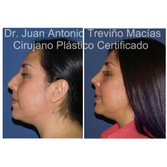 Rinoplastia - Centro de Cirugía Plástica. Dr. Juan Antonio Treviño Macías